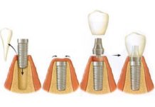 Особенности установки имплантов