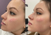 Филлеры в Москве: Современный Подход к Красоте и Омоложению
